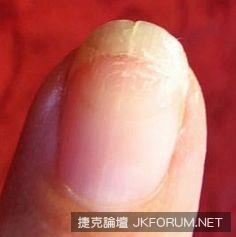 從指甲的狀態看出你的健康狀況，來看看你中了幾項！
