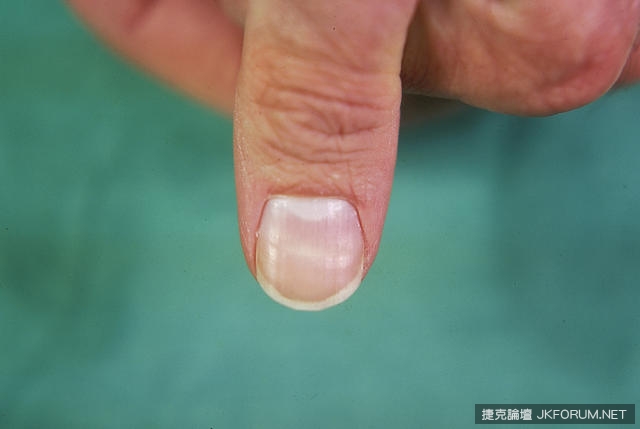 從指甲的狀態看出你的健康狀況，來看看你中了幾項！