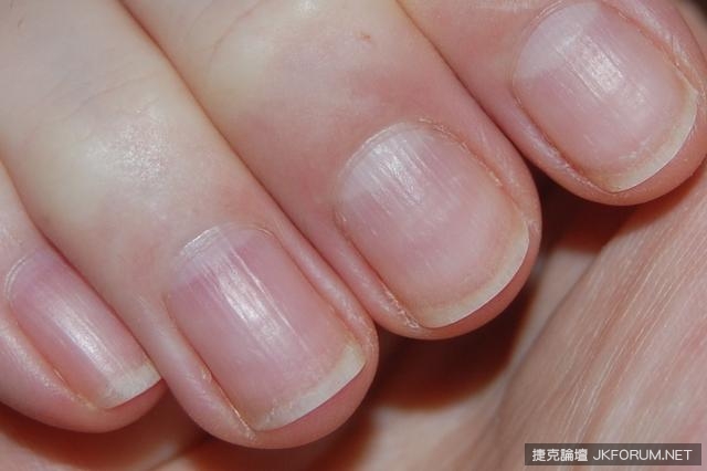從指甲的狀態看出你的健康狀況，來看看你中了幾項！