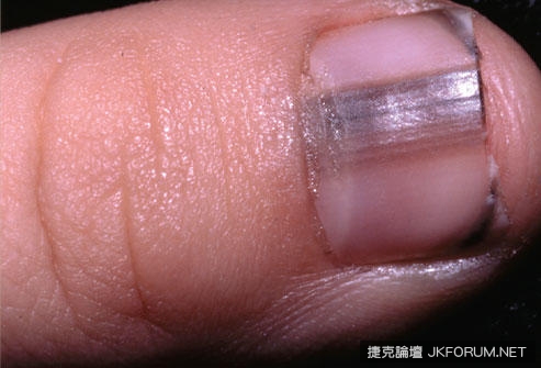 從指甲的狀態看出你的健康狀況，來看看你中了幾項！