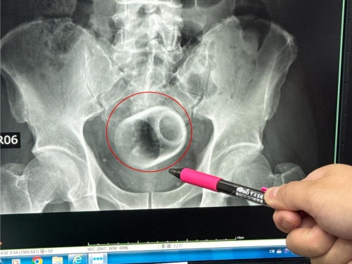 繼椰子男後又見「瓷杯男」肛門塞3天險喪命