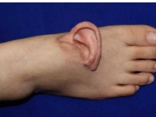 被機器扯走整片頭皮！山東女工「腳背養耳朵」5個月 奇蹟成功植回