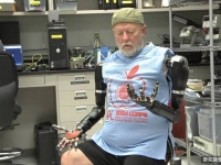 失去雙臂的男子 獲準取得全球第一對用「腦」控制的機器雙手