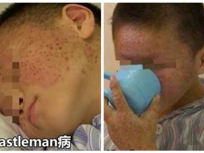 江蘇12歲怪病男孩膚如蟾蜍