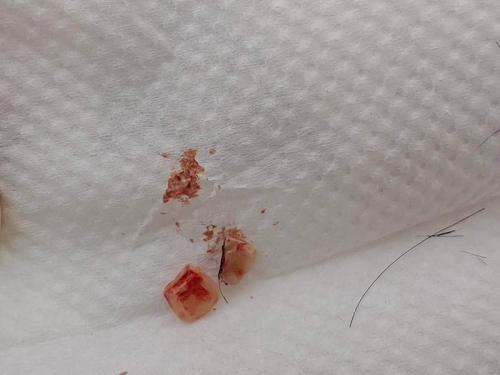 打籃球撞斷對手2顆牙 6天後飄腐臭味驚見「斷牙嵌在頭上」