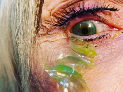 舊的不拔直接帶新的！老婦眼中堆23片隱形眼鏡 取出全部發綠