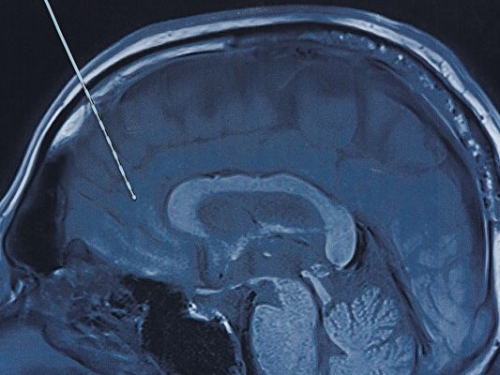 電極植入大腦或可喚醒深度昏迷
