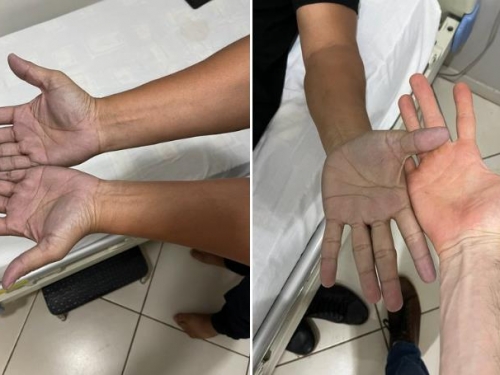 男見雙手發紫 以為快死了！ 衝急診室結果卻超糗