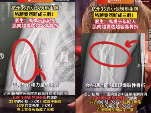 2男「鴨手霸」用力過猛　骨頭當場斷成三截送醫