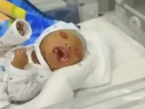 亂倫悲劇！男嬰全身「布滿魚鱗」 出生2小時後夭折死於保溫箱