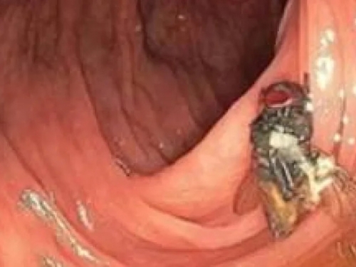 我的結腸內有蒼蠅！ 他做大腸鏡檢查驚見「嬌客停腹中」 ：沒感覺