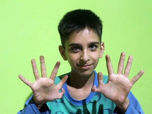 印度12歲男孩天生雙手“六指”稱有助於贏得電子遊戲