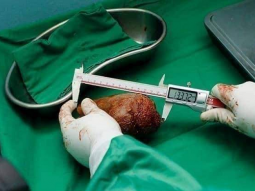 斯里蘭卡老兵腹痛開刀 驚見801克「世界最大腎結石」
