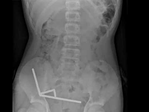紐西蘭13歲少年吞下百顆網購磁鐵 X光片驚見「4條直線」