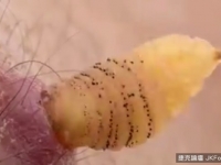 慎入！專家任蟲卵在體內寄生　從皮膚蹦出那刻嚇死人啦