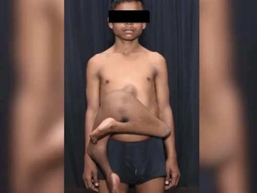 肚子多長一雙腿！印度17歲少年「寄生雙胞胎」附著胸骨上