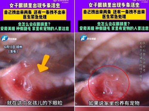 養貓女眼皮發癢發紅 竟是眼皮下有「這生物」