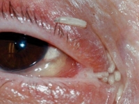 噁！蒼蠅入侵產卵...加拿大女眼鼻內有120條「蛆」