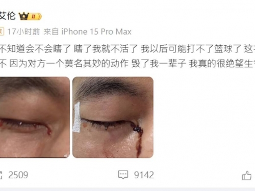 CBA／球星郭艾倫發文：相信會重返球場 曾遭隊員戳眼致結膜破碎