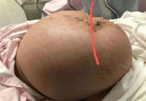 19歲女生子 肚藏巨瘤…比孩大5倍