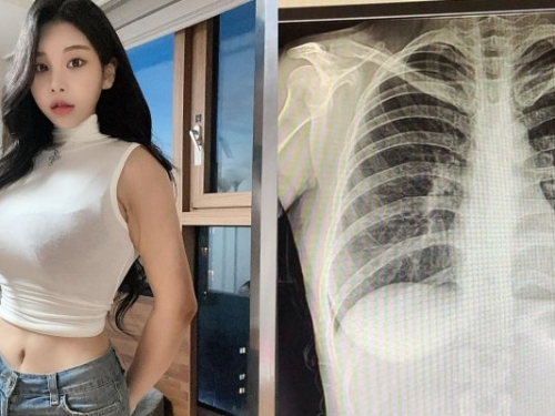南韓「百萬網紅」不滿被質疑整形...曬 X 光照自證清白：我沒有動過手術