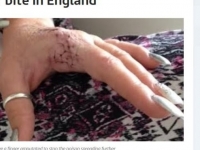 「假黑寡婦蜘蛛」咬一口　英美髮師手指龜裂流黑膿