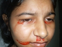 一哭身體就流血「上課染紅襯衫」　印少女：我是怪胎？