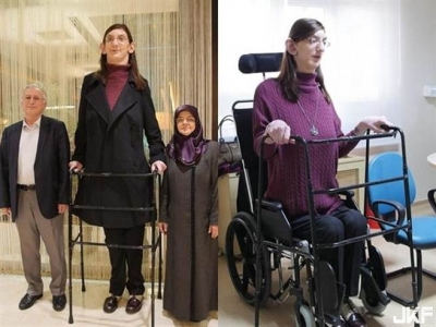 十九歲女孩身高213公分 太高無法走路