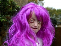 英女童患早衰症　年僅11歲似80歲老太太