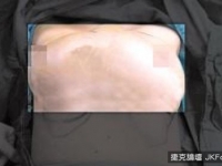 想豐胸小心風險？　 女子「雙乳」變一個巨乳