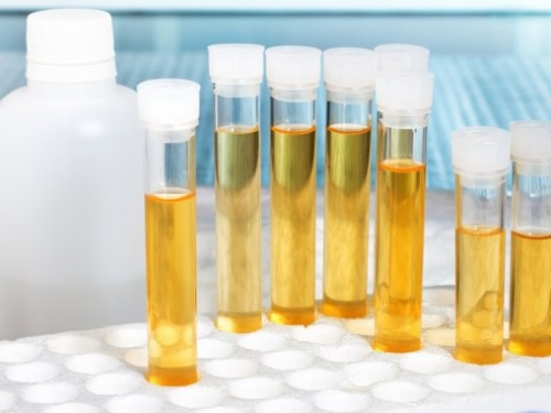 膀胱癌有望透過尿液檢測提早十年發現