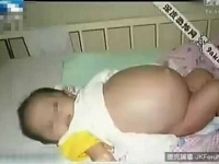嬰兒生嬰兒？7月大男嬰「懷孕」　剖腹產下寄生妹妹