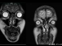醫師每次照核磁共振，都像地獄走一遭