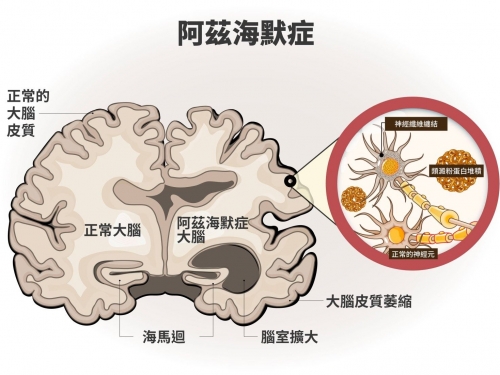 失智症的「腺」索：從腺苷研究到阿茲海默症新藥開發