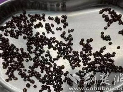 腹痛半年以為胃病 婦人膽竟塞「百顆魚子醬」