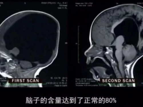 全球首個沒有“大腦”男孩，腦袋98％都是血，奇蹟般的活了下來