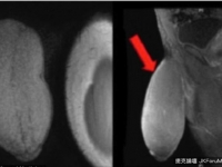 史上首例「下體縮小術」　美少年擁葡萄柚大巨鵰