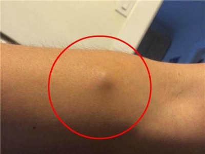 男子手臂莫名突起 開刀竟取出怪異物