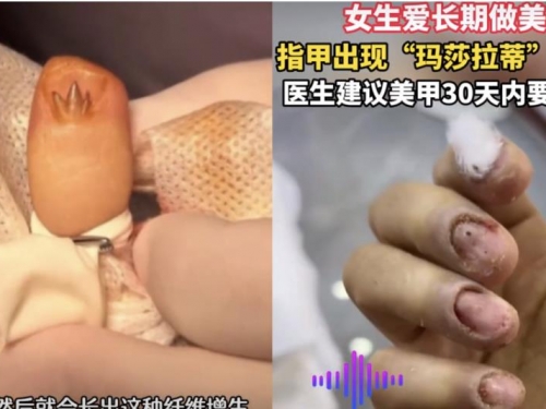 女長期做美甲竟長出「瑪莎拉蒂三叉戟」醫生一看慘了