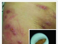 皮膚異常搔癢　男手術夾出20隻「白胖活蛆」