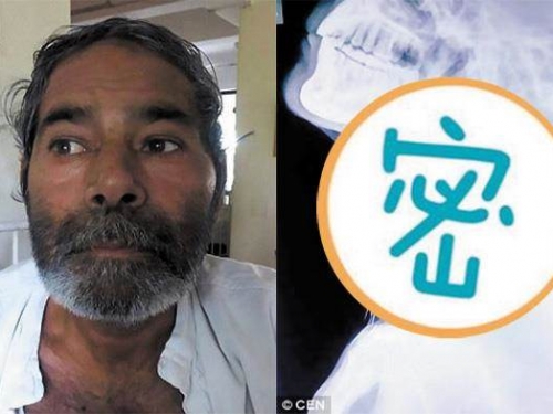 印度男莫名身體痛就醫 一照X光讓醫生嚇壞了