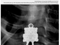 阿拉伯孩童誤食不明物品　X光片讓醫生當場驚聲尖叫