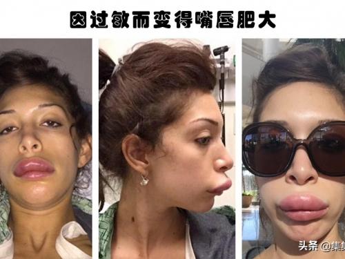 整容失敗的代價：據說因為整容而毀掉了自己容貌的6個人