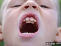 罕見！　男童口中長出「第二組牙齒」