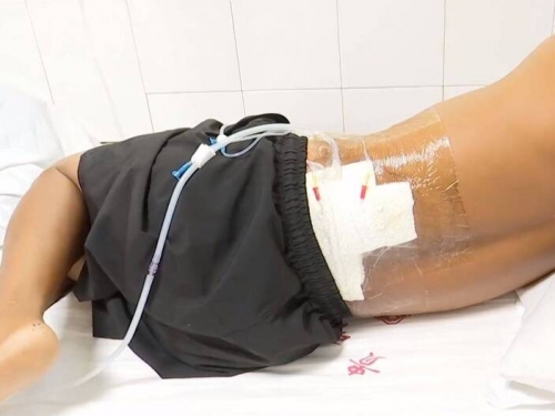 衰男5分鐘遭2次雷擊！三度燒傷還自行報警求救