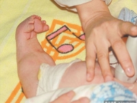 現實版「美人魚」：原來是疾病「美人魚綜合症」？