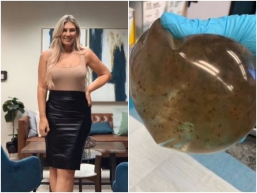 女遭怪病纏身10年 開刀驚見隆乳鹽水袋變超噁「沼澤水」