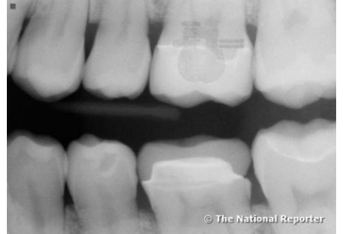 美國男子牙齒疑遭外星人植入信號發收器？