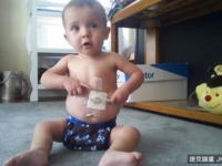 「奇蹟寶寶」　在媽媽肚裡成功進行腫瘤摘除手術