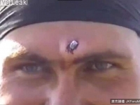 魔鬼終結者？別人用鉗子將他額頭上的子彈取出時，整個過程讓人驚訝…